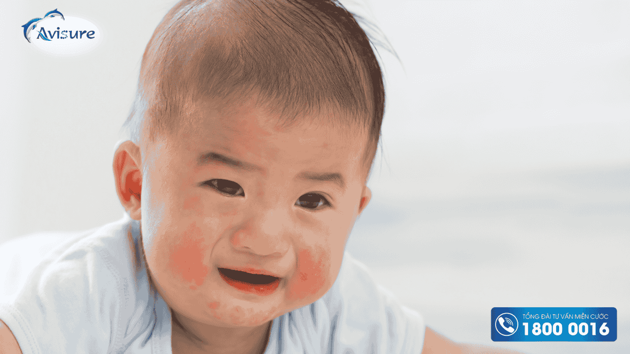 Bổ sung men vi sinh probiotic giúp ngăn ngừa tình trạng dị ứng ở trẻ